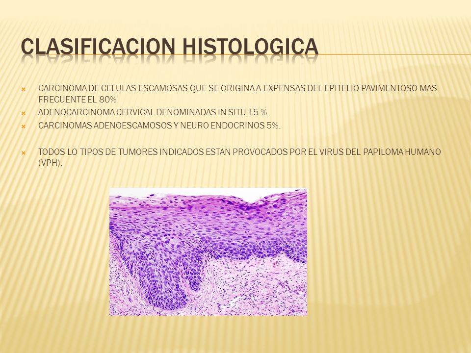 clasificación histológica cáncer de próstata